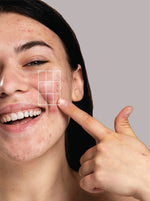 Anti Bacterial Acne Cream