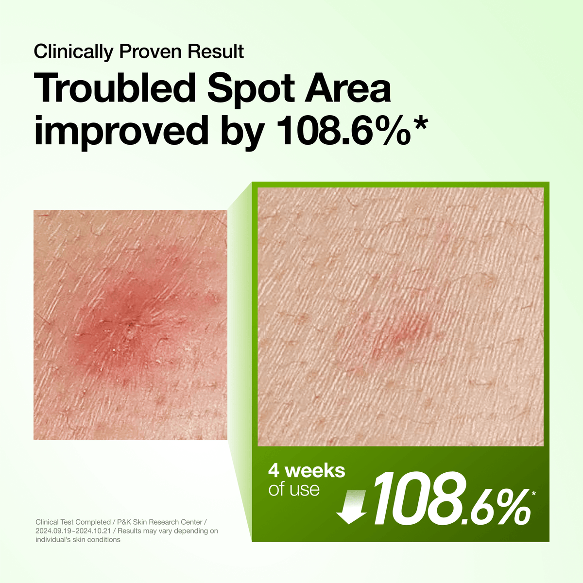 Azelaic Acid 10 Hyaluron Redness Soothing Serum - Anua